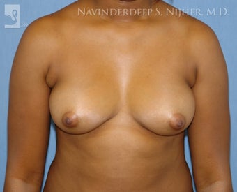 Breast Augmentation before 501004