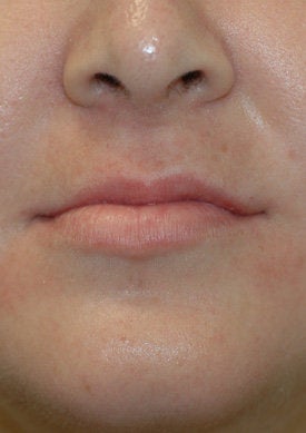 Restylane lip injections before 93353