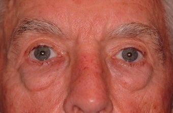Extended lower lid blepharoplasty before 480035