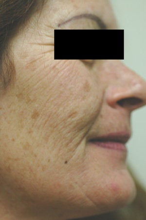 Photofacial before 151338