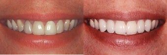 Porcelain Veneers before 313052