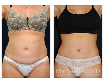 Abdominoplasty - Tummy Tuck before 396091