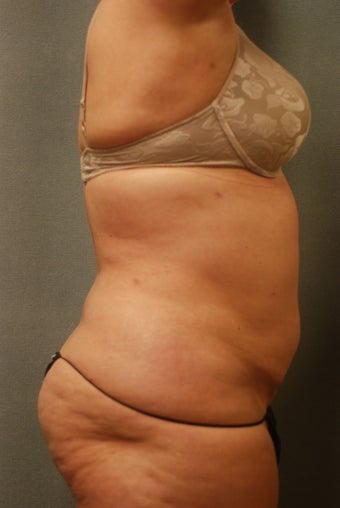 SmartLipo Complete Wrap around after 346597