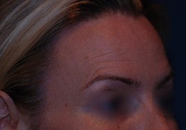 Botox 555513