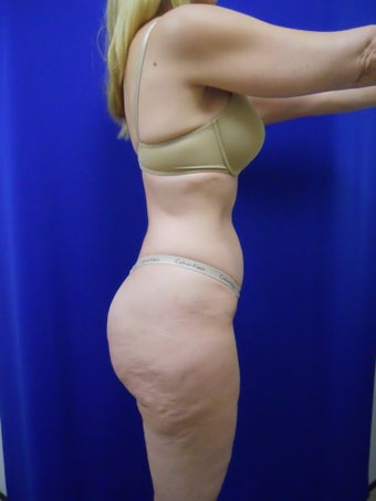 Zerona 338888