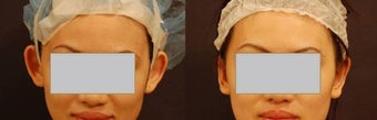 Ear pinning Otoplasty before 584397