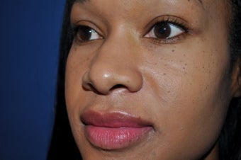 33 year-old female Rhinoplasty before 279303