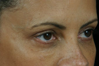 Restylane after 309258