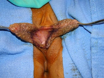Labia Reduction Surgery before 146353