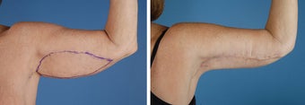 Arm Lift (Brachioplasty) before 303695