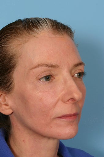 Fraxel Laser treatment after 88693