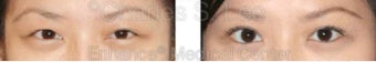 Blepharoplasty before 427712