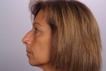 Fat Transfer before 253142