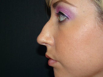 Rhinoplasty before 267942