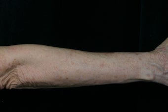 Dual Fraxel Laser after 309244
