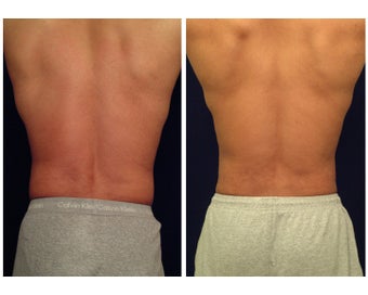 Liposuction after 397015
