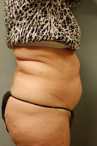 SmartLipo™ 65 Yr Old Female Abs/upper & Lower Flanks, Waist 451399