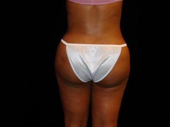 Buttocks Augmentation after 517504