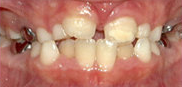 Two-Phase Orthodontic Treatment 344259