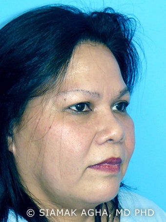 Rhinoplasty after 177462