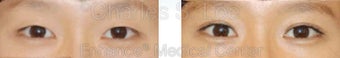 Blepharoplasty before 427707