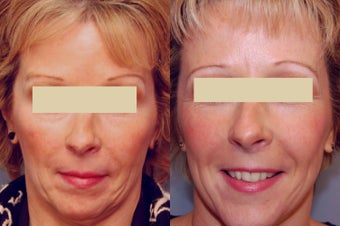 Sculptra treatments after 125334