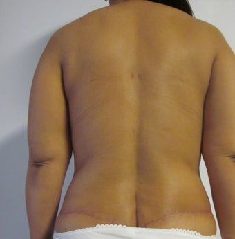 Mommy Makeover: Abdominoplasty/ Liposuction/ Mastopexy/ Beltectomy 562482