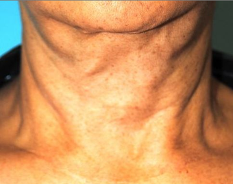 Exilis before 424064