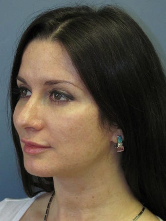 Neck Lift, Platysmaplasty 634730