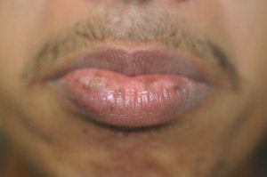 Brown Spots on the Lips before 179156