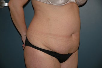 Tummy tuck before 144255