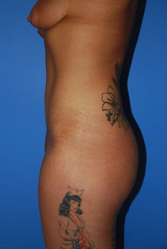 Abdominoplasty 342442