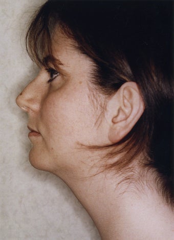 Neck Liposuction 628887