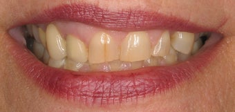 Porcelain Veneers 510792