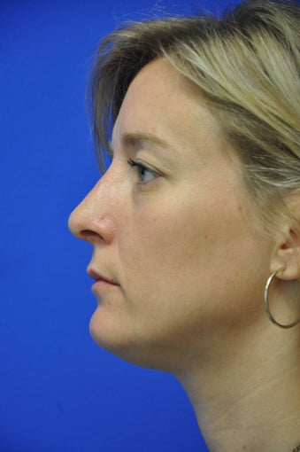 Nasal airway surgery with cosmetic improvment after 478783