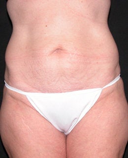 Tummy Tuck with Flank Liposuction before 330911
