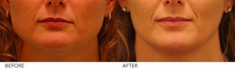 Botox Jaw Reduction before 242877