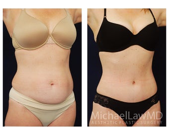 Abdominoplasty - Tummy Tuck after 396017
