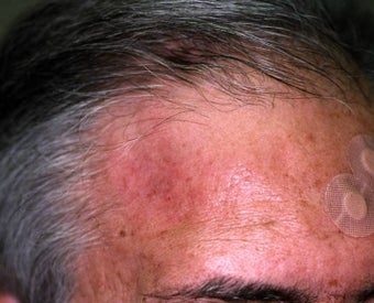 Liquid Injectable Silicone after 149190