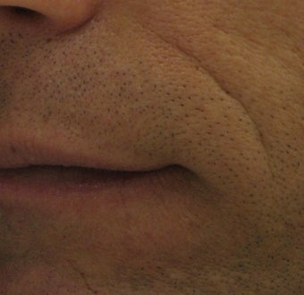 Belotero for fine etched-in lines in nasolabial folds before 633104