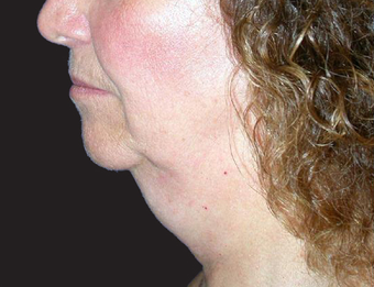 Neck Lift before 229650