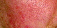 Photofacial before 272077