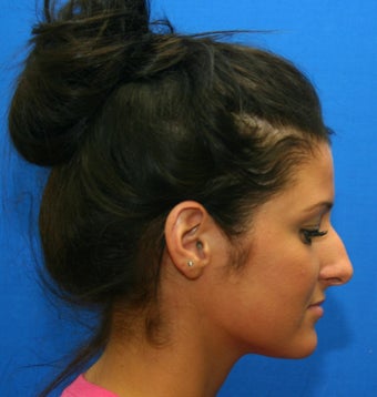 Rhinoplasty (nose job) before 532519
