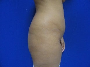 Brazilian Butt Lift before 476130