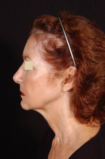 Liposuction of Neck before 155332