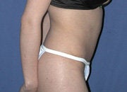 Abdominoplasty after 151311
