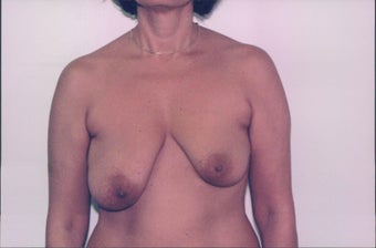Breast Lift before 218954