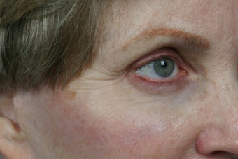 Botox 309232