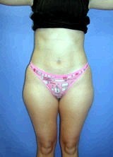 Liposuction Surgery before 157192