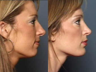 Nose Surgery after 338485